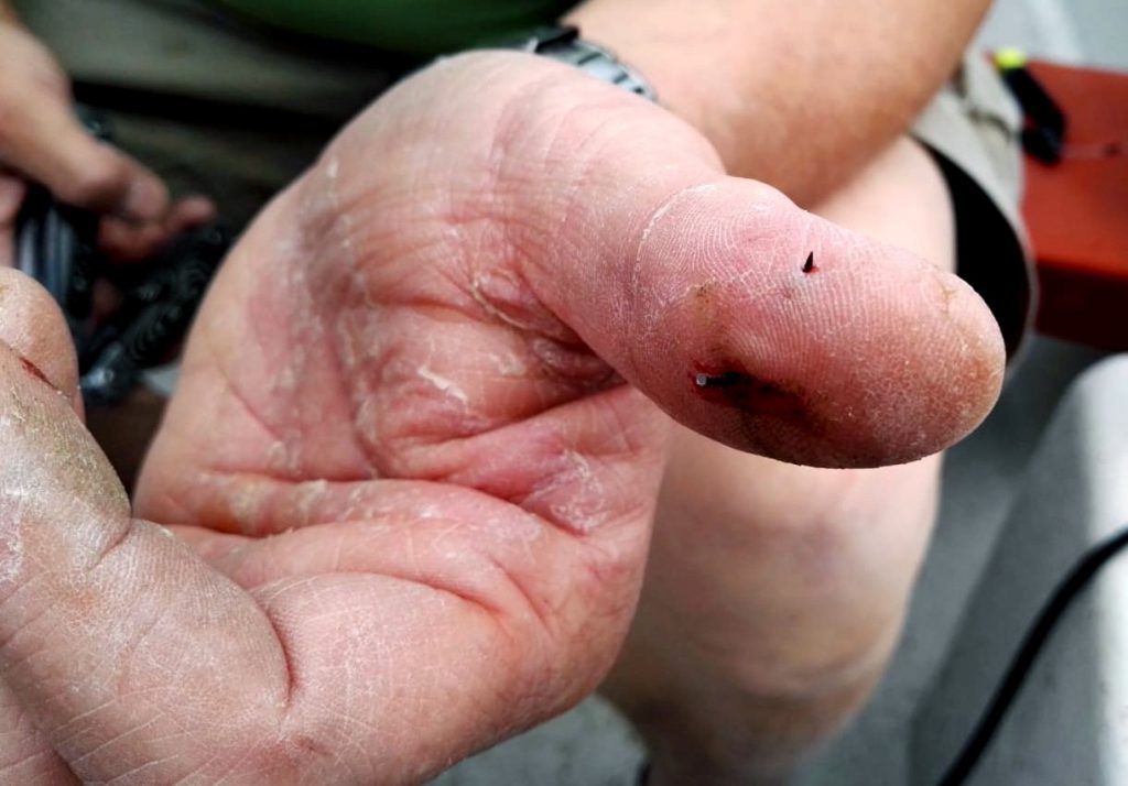 Angeln Trolling in Schweden, Anleitung-Haken aus dem Finger entfernen